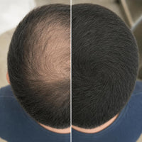 Resultados en hombres — antes y después