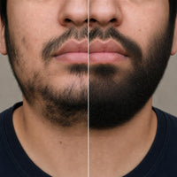 Resultados en barba — antes y después